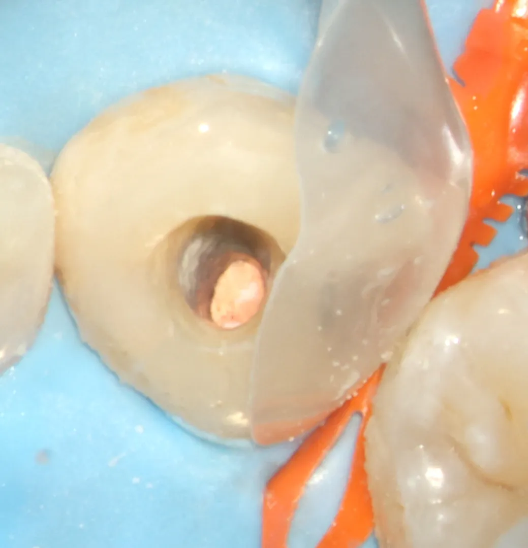 Clinical photo during sodium perborate application showing internal bleaching procedure in progress